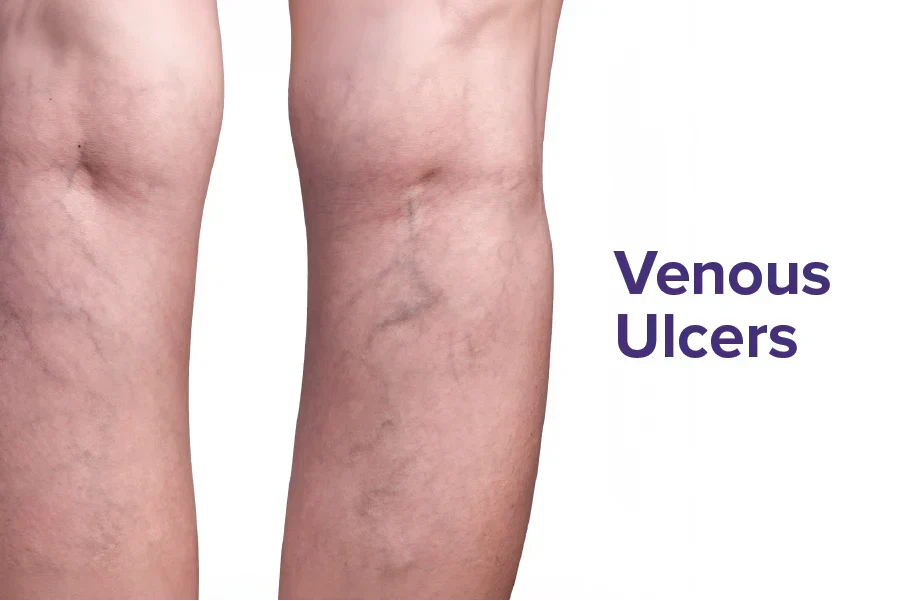 Venous Ulcers Explained: Why They Occur and How to Manage Them