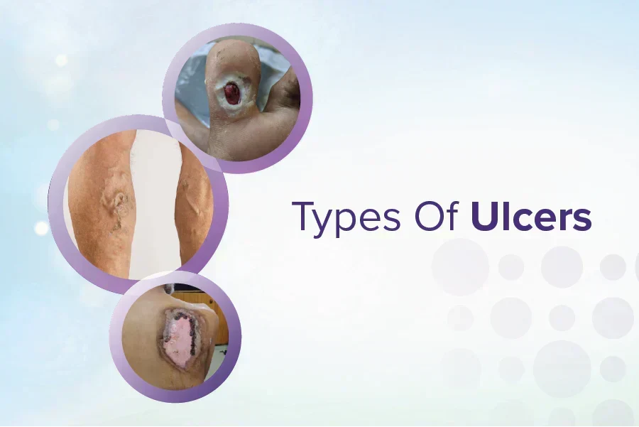 Types of Ulcers: Causes, Symptoms, and Treatment Options