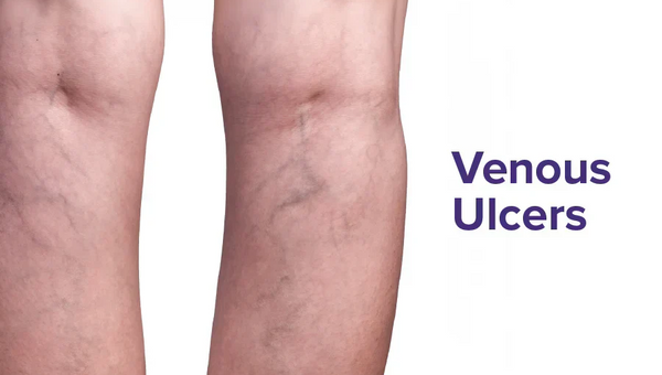 Venous Ulcers Explained: Why They Occur and How to Manage Them