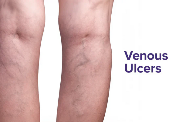 Venous Ulcers Explained: Why They Occur and How to Manage Them