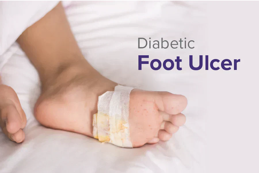 Diabetic Foot Ulcer: Causes, Stages, Treatment, and Prevention