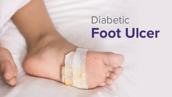 Diabetic Foot Ulcer: Causes, Stages, Treatment, and Prevention