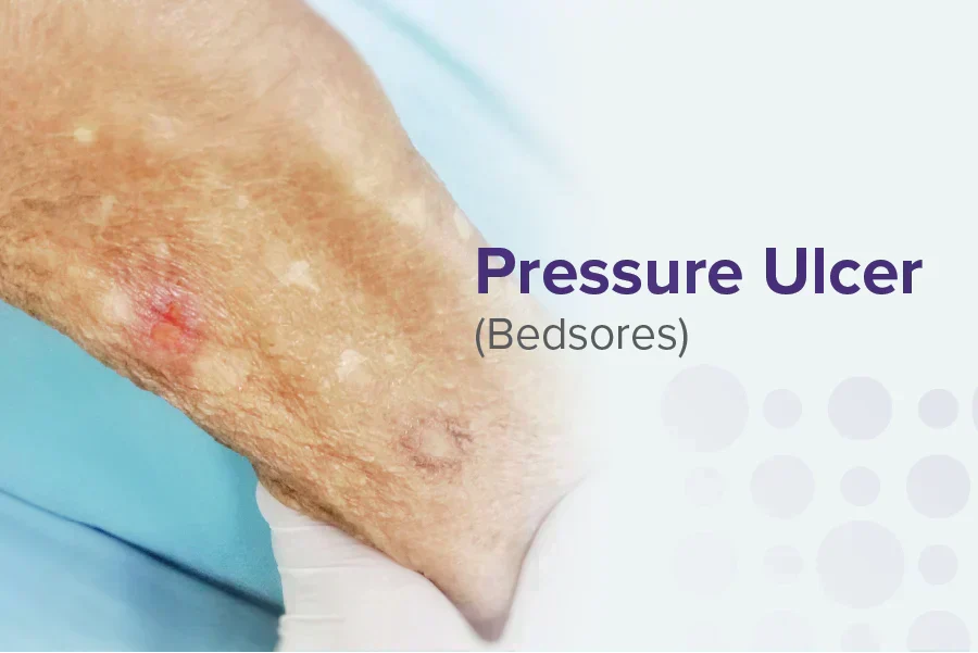 Pressure Ulcer (Bedsores): Stages, Causes, and Treatment Options