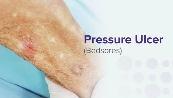 Pressure Ulcer (Bedsores): Stages, Causes, and Treatment Options