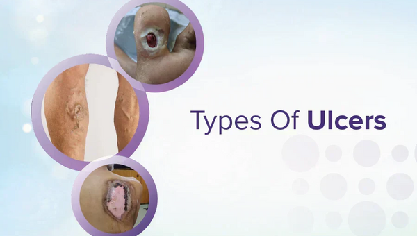 Types of Ulcers: Causes, Symptoms, and Treatment Options